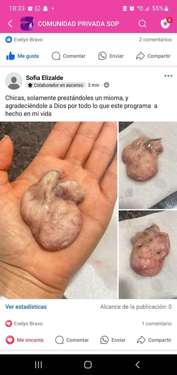 Fibroid released — student, 3-month protocol